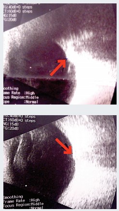 
			Аденома гипофиза и хиазмальный синдром. Часть 2. Методы лечения		