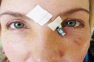 
			Лечение слезотечения. Часть 2 		