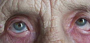 
			Лечение слезотечения. Часть 2 		