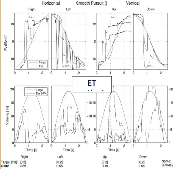 Периферический вестибулярный синдром
Периферический вестибулярный синдром