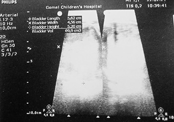 
			Нейрогенный мочевой пузырь		