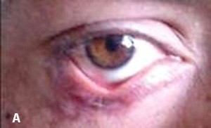 
			Лагофтальм: осложнения и лечение		