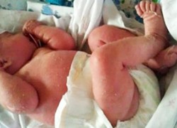 Ранняя диагностика тяжелых комбинированных иммунодефицитов		 
			Ранняя диагностика тяжелых комбинированных иммунодефицитов