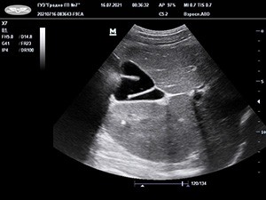 
			Аномалии развития билиарного тракта у детей и их клинико-патогенетическое значение		