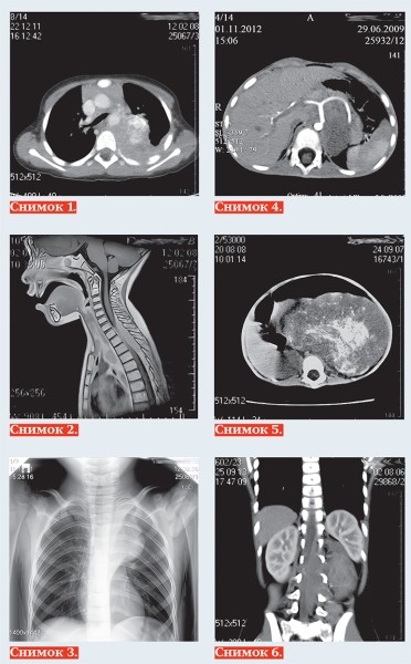 
			Нейробластома у детей: пути снижения запущенных случаев		