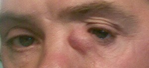 
			Лечение слезотечения. Часть 2 		