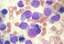 
			Острый миелоидный лейкоз у детей		