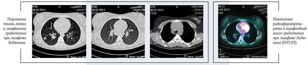 
			Лимфома Ходжкина у детей и подростков		