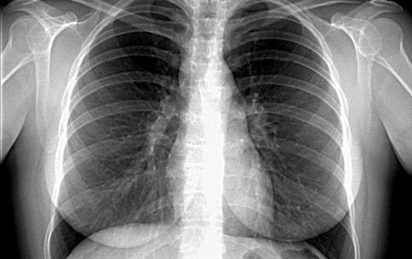 Саркоидоз: нерешенные задачи
Саркоидоз: нерешенные задачи