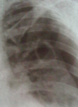 
			О терапии деструктивных форм туберкулеза легких 		