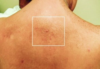 
			Онкоэндокринология: синдром множественной эндокринной неоплазии 2А типа		