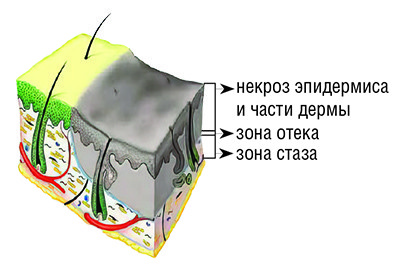 
			Ожоги: принципы диагностики и выбор тактики лечения. Часть 1		