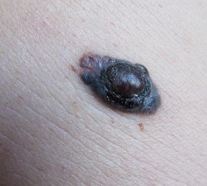 
			 О важности ранней диагностики меланомы кожи		