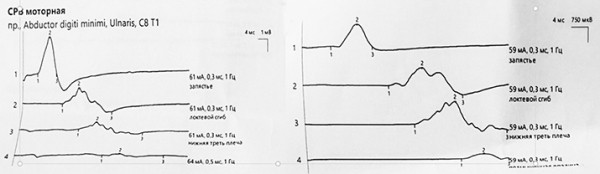 SARS-CoV-2 как триггер дебюта и прогрессирования неврологических заболеваний. Часть 2
SARS-CoV-2 как триггер дебюта и прогрессирования неврологических заболеваний. Часть 2