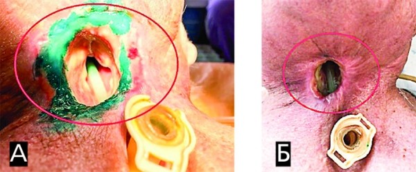 
			Онкологические заболевания гортани. Еще раз о важности регулярного наблюдения у профильных специалистов		