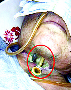 
			Онкологические заболевания гортани. Еще раз о важности регулярного наблюдения у профильных специалистов		