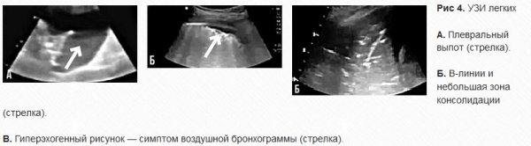 
			УЗИ легких у пациентов с CoViD-19: опыт китайских специалистов. Часть 1		