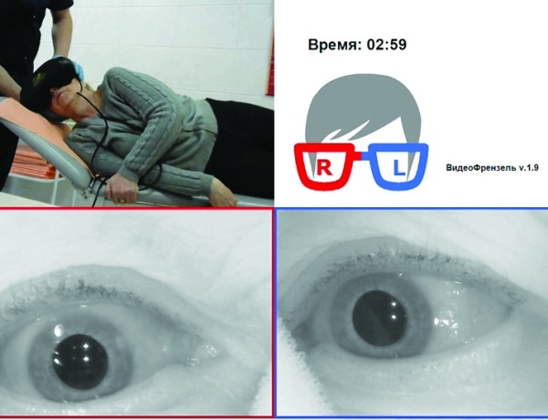 
			Доброкачественное позиционное пароксизмальное головокружение		