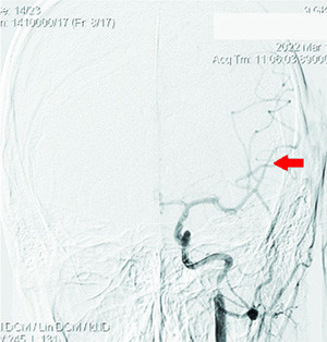 
			Острый ишемический инсульт у подростка: опыт комбинированного внутрисосудистого тромболизиса		
