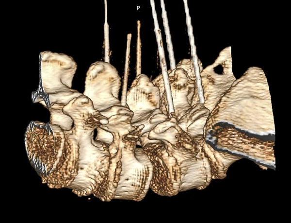 
			Фасеточный синдром: радиочастотная денервация фасеточных суставов		