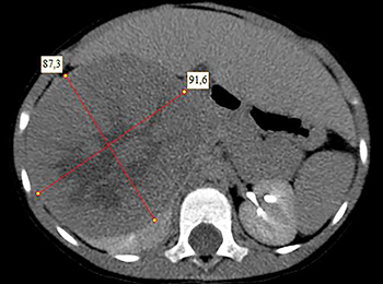 
			Нефробластомы у детей: что необходимо знать		