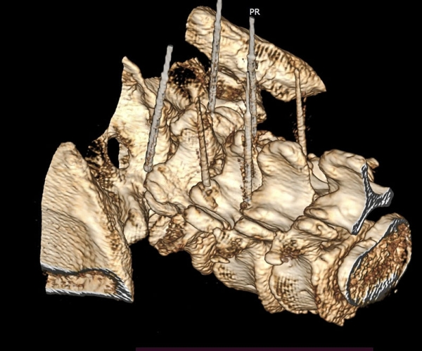 
			Фасеточный синдром: радиочастотная денервация фасеточных суставов		