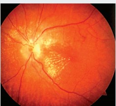 
			Аденома гипофиза и хиазмальный синдром. Часть 2. Методы лечения		