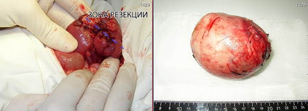 
			Нефробластомы у детей: что необходимо знать		